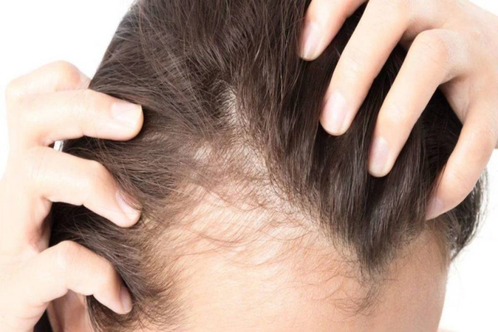 Hair Loss at Young Age in Men