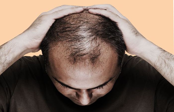 What Causes Hair Loss at Young Age in Men_